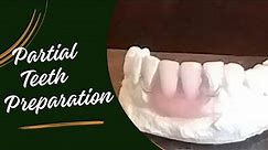 Partial teeth preparation | partial denture procedure | how to make partial denture step by step