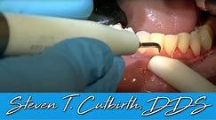 Scaling & Root Planing - Dental Minute with Steven T. Cutbirth, DDS