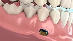LOCATOR Implant Attachment System | Zest Dental Solutions