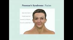 Noonan's Syndrome - CRASH! Medical Review Series