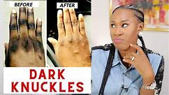 HOW TO GET RID OF DARK KNUCKLES | Causes & Treatment | Skincare Specialist