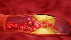 Hyperlipidemia Arteriosclerosis Blocked Artery Concept Human Stock Footage Video (100% Royalty-free) 1108110105 | Shutterstock