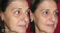 What is CO2 Laser Treatment? - Before and Afters
