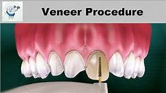Dental Veneers Procedure Step by step