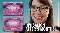 INVISALIGN BEFORE & AFTER // Deep Bite + Crowding Treatment