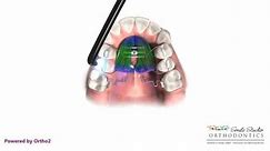 Pendex - Orthodontic Appliance