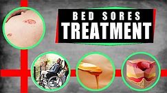Bed Sores Treatment: How to Treat Bed Sores at Home – Top 5 Remedies for Bed Sores