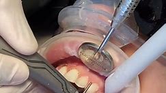 First step of porcelain #veneers #veneersjourney #teeth #prep #dentist #process #behindthescenes #cosmeticdentist