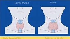 #thyroid #thyroidawareness #thyroidproblems #thyroiddisorders #thyroidfood #trending #youtube