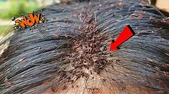 Omg Thousand big lice on lady head - Lice removal