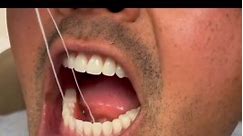 Dentistry World on Instagram: "🥩 Retentive Complete #dentures with no #dentalimplants . Centric and functional movements performed. (Econ. Dentures.) .By.. @dr.jameslee #dentallab #dentalschool #dentalstudents #stomatology #odontologia #denturist"