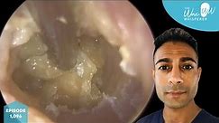 1,096 - Complex Swollen & Infected Ear Wax Removal