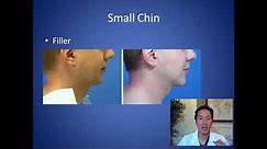 How Can I Make my Chin Larger - Chin Implant Consultation - Dr. Anthony Youn