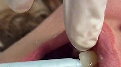 Bite register #dentist #teeth #fyp #veneers #pvs