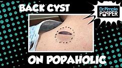 Back Cyst on a Popaholic... baby!