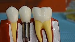 Dental Implant Vs Dental Bridge