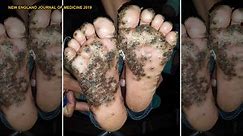 Girl's feet infested with parasitic fleas after running through pigsty barefoot