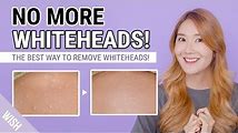 How to Remove Whiteheads at Home with Natural Remedies