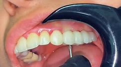Upper Implantation and Dental Hygiene: A Comprehensive Guide