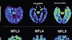 Closer to diagnosing NFL brain disease?