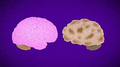 How Alzheimer's destroys the brain