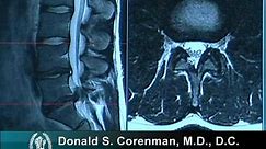How to Read a MRI of a Lumbar Herniated Disc | Lower Back Pain | Colorado Spine Surgeon