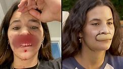 Model whose lip was bitten off by dog shows off transformation after six surgeries