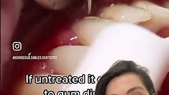 Why Oral Hygiene Is Important?!