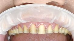 A Close-up of the brilliant work of Veneers! https://smile.dentakay.com/facebook-en/ • • • • • • • • #Dentalveneers #veneersplacement #smiledesign #Hollywoodsmile #cosmeticdentistry #Zirconcrowns #teeth #orthodontics #StrongTeeth #porcelainveneers #instagood #explorerpage | Dentakay Dental Clinic