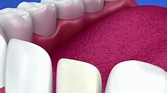 Dental Veneers Procedure | 3D Animation #cosmeticdentistry #veneer | Dental Daily