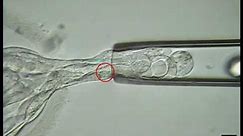IVF - Embryo Biopsy Procedure Tests Embryos For Genetic Abnormalities