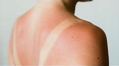 How To Treat Sunburn At Home | Rachael's Dermatologist Dr. Anne Chapas