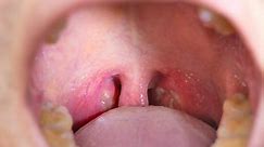 Do you need your tonsils removed?