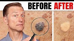 How to Remove Skin Tags and Warts Overnight - Dr. Berg Explains - Dr. Eric Berg DC