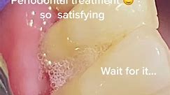 Periodontal gum treatment “deep cleaning” “scaling” #satisfying | periodontal scaling