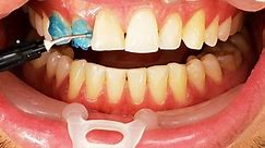 Satisfying dental veneers procedure
