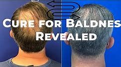 Revolutionary Cure for Baldness Revealed: Your Hairy Moles Hold the Secret