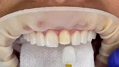 #veneers #teeth #porcelainveneers #cosmeticdentistry #dental #trending | teeth