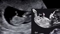 Find out the gender of your baby as early as 12 weeks! #genderreveal #pregnancy #babyontheway #pregnant #pregnantlife #pregnancyannouncement #babyshower | Prenatal Ultrasounds