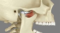 Temporomandibular Joints Dislocated Articular Disc Medically Stock Footage Video (100% Royalty-free) 1097110263 | Shutterstock