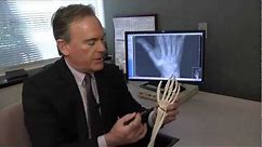 Treating Basal Thumb Joint Arthritis - Mayo Clinic