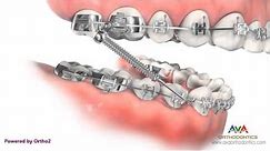 Orthodontic Treatment for Overjet (Overbite) - Forsus Appliance