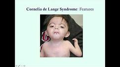 Cornelia de Lange Syndrome - CRASH! Medical Review Series