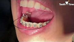 Braces wires - from wire 016 to a niti 18x25 - Tooth Time Family Dentistry New Braunfels