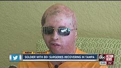 Second most wounded Iraq soldier recovering in Tampa