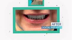 Before dental implants vs after dental implants