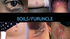 #boils 7 Facts about Boils