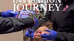 Invisalign Journey Day 1 ✔️ #invisalign #invisalignsmile #comewithmetothedentist #smile #fyp #dental