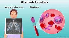 Diagnosing Asthma: Mild, Moderate, and Severe