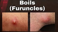 Say Goodbye to Boils: Discover the Causes, Risk Factors, and Effective Treatment